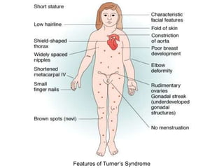 Features of Turner’s Syndrome
 
