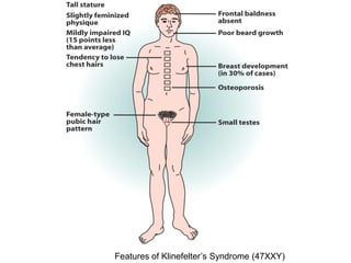 Features of Klinefelter’s Syndrome (47XXY)
 