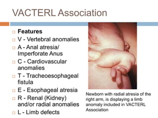 VACTERL Association
   Features
   V - Vertebral anomalies
   A - Anal atresia/
    Imperforate Anus
   C - Cardiovascular
    anomalies
   T - Tracheoesophageal
    fistula
   E - Esophageal atresia
                              Newborn with radial atresia of the
   R - Renal (Kidney)        right arm, is displaying a limb
    and/or radial anomalies   anomaly included in VACTERL
                              Association
   L - Limb defects
 