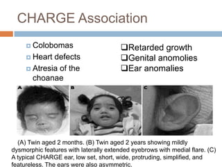 CHARGE Association
      Colobomas                        Retarded growth
      Heart defects                    Genital anomolies
      Atresia of the                   Ear anomalies
       choanae




  (A) Twin aged 2 months. (B) Twin aged 2 years showing mildly
dysmorphic features with laterally extended eyebrows with medial flare. (C)
A typical CHARGE ear, low set, short, wide, protruding, simplified, and
featureless. The ears were also asymmetric.
 