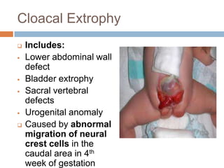 Cloacal Extrophy
   Includes:
   Lower abdominal wall
    defect
   Bladder extrophy
   Sacral vertebral
    defects
   Urogenital anomaly
   Caused by abnormal
    migration of neural
    crest cells in the
    caudal area in 4th
    week of gestation
 