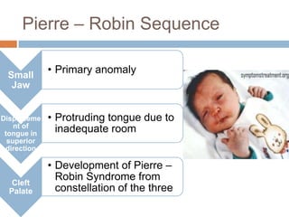 Pierre – Robin Sequence

 Small
             • Primary anomaly
  Jaw


Displaceme   • Protruding tongue due to
    nt of
 tongue in
               inadequate room
  superior
 direction

             • Development of Pierre –
   Cleft
               Robin Syndrome from
  Palate       constellation of the three
 