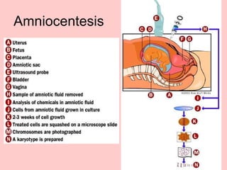 Amniocentesis 