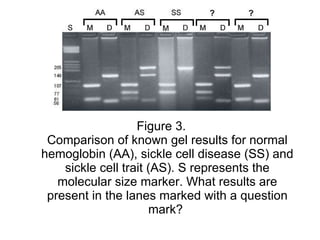 Figure 3. Comparison of known gel results for normal hemoglobin (AA), sickle cell disease (SS) and sickle cell trait (AS). S represents the molecular size marker. What results are present in the lanes marked with a question mark?  
