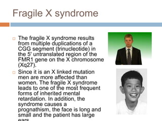 Fragile X syndrome

   The fragile X syndrome results
    from multiple duplications of a
    CGG segment (trinucleotide) in
    the 5' untranslated region of the
    FMR1 gene on the X chromosome
    (Xq27).
   Since it is an X linked mutation
    men are more affected than
    women. The fragile X syndrome
    leads to one of the most frequent
    forms of inherited mental
    retardation. In addition, the
    syndrome causes a
    prognathism, the face is long and
    small and the patient has large
 