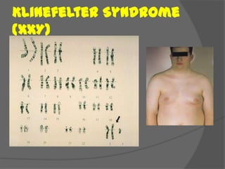 Klinefelter Syndrome
(XXY)
 