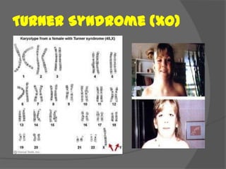 Turner Syndrome (XO)
 