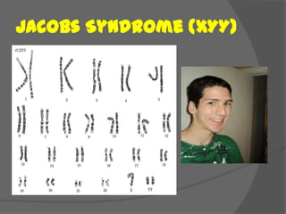 Jacobs Syndrome (XYY)
 