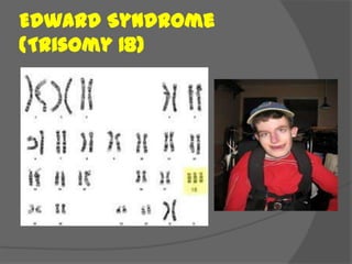 Edward Syndrome
(Trisomy 18)
 
