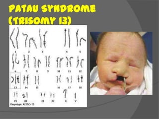 Patau Syndrome
(Trisomy 13)
 