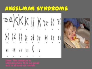 Angelman Syndrome




Note: The deletion in
Chromosome 15 is so small
and is almost not visible
 