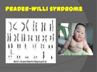 Prader–Willi syndrome
 
