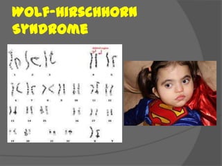 Wolf-Hirschhorn
Syndrome
 