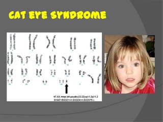 Cat eye Syndrome
 
