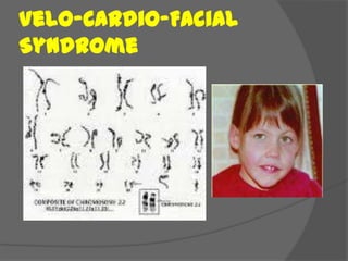 Velo-Cardio-Facial
Syndrome
 