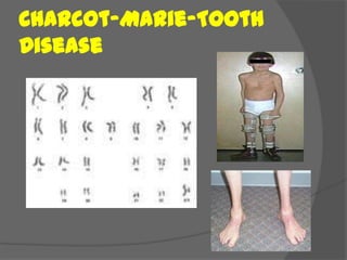 Charcot-Marie-Tooth
Disease
 