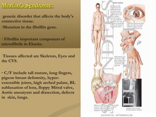 Marfan’s Syndrome:Marfan’s Syndrome:
genetic disorder that affects the body's
connective tissue.
Mutation in the fibrillin gene.
 Fibrillin important component of
microfibrils in Elastin.
Tissues affected are Skeleton, Eyes and
the CVS.
 C/F include tall stature, long fingers,
pigeon breast deformity, hyper-
extensible joints, high arched palate, BL
subluxation of lens, floppy Mitral valve,
Aortic aneurysm and dissection, defects
in skin, lungs.
 