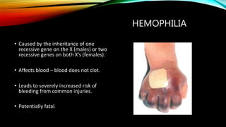 HEMOPHILIA
• Caused by the inheritance of one
recessive gene on the X (males) or two
recessive genes on both X’s (females).
• Affects blood – blood does not clot.
• Leads to severely increased risk of
bleeding from common injuries.
• Potentially fatal.
 