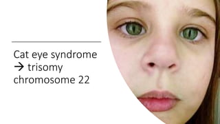 Cat eye syndrome
 trisomy
chromosome 22
 