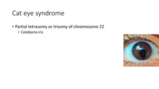 Cat eye syndrome
• Partial tetrasomy or trisomy of chromosome 22
• Coloboma iris
 