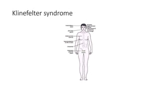 Klinefelter syndrome
 