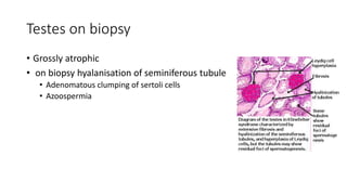 Testes on biopsy
• Grossly atrophic
• on biopsy hyalanisation of seminiferous tubule
• Adenomatous clumping of sertoli cells
• Azoospermia
 