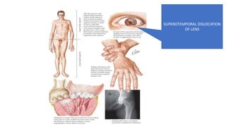 SUPEROTEMPORAL DISLOCATION
OF LENS
 