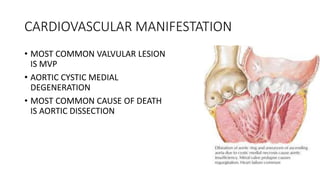 CARDIOVASCULAR MANIFESTATION
• MOST COMMON VALVULAR LESION
IS MVP
• AORTIC CYSTIC MEDIAL
DEGENERATION
• MOST COMMON CAUSE OF DEATH
IS AORTIC DISSECTION
 