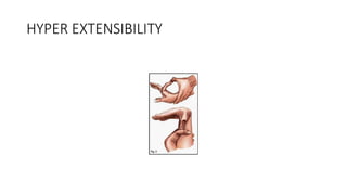 HYPER EXTENSIBILITY
 
