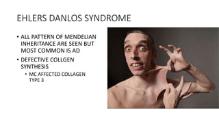 EHLERS DANLOS SYNDROME
• ALL PATTERN OF MENDELIAN
INHERITANCE ARE SEEN BUT
MOST COMMON IS AD
• DEFECTIVE COLLGEN
SYNTHESIS
• MC AFFECTED COLLAGEN
TYPE 3
 