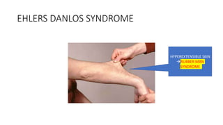 EHLERS DANLOS SYNDROME
HYPEREXTENSIBLE SKIN
RUBBER MAN
SYNDROME
 