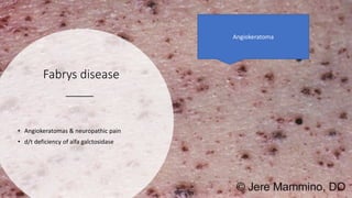 Fabrys disease
• Angiokeratomas & neuropathic pain
• d/t deficiency of alfa galctosidase
Angiokeratoma
 
