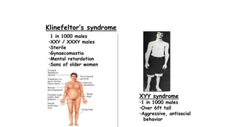 1 in 1000 males
•XXY / XXXY males
•Sterile
•Gynaecomastia
•Mental retardation
•Sons of older women
XYY syndrome
•1 in 1000 males
•Over 6ft tall
•Aggressive, antisocial
behavior
Klinefeltor’s syndrome
 