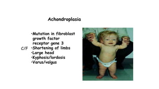 Achondroplasia
•Mutation in fibroblast
growth factor
receptor gene 3
•Shortening of limbs
•Large head
•Kyphosis/lordosis
•Varus/valgus
C/F
 