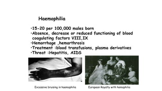 Haemophilia
•15-20 per 100,000 males born
•Absence, decrease or reduced functioning of blood
coagulating factors VIII,IX
•Hemorrhage ,hemarthrosis
•Treatment :blood transfusions, plasma derivatives
•Threat :Hepatitis, AIDS
European Royalty with hemophiliaExcessive bruising in haemophilia
 
