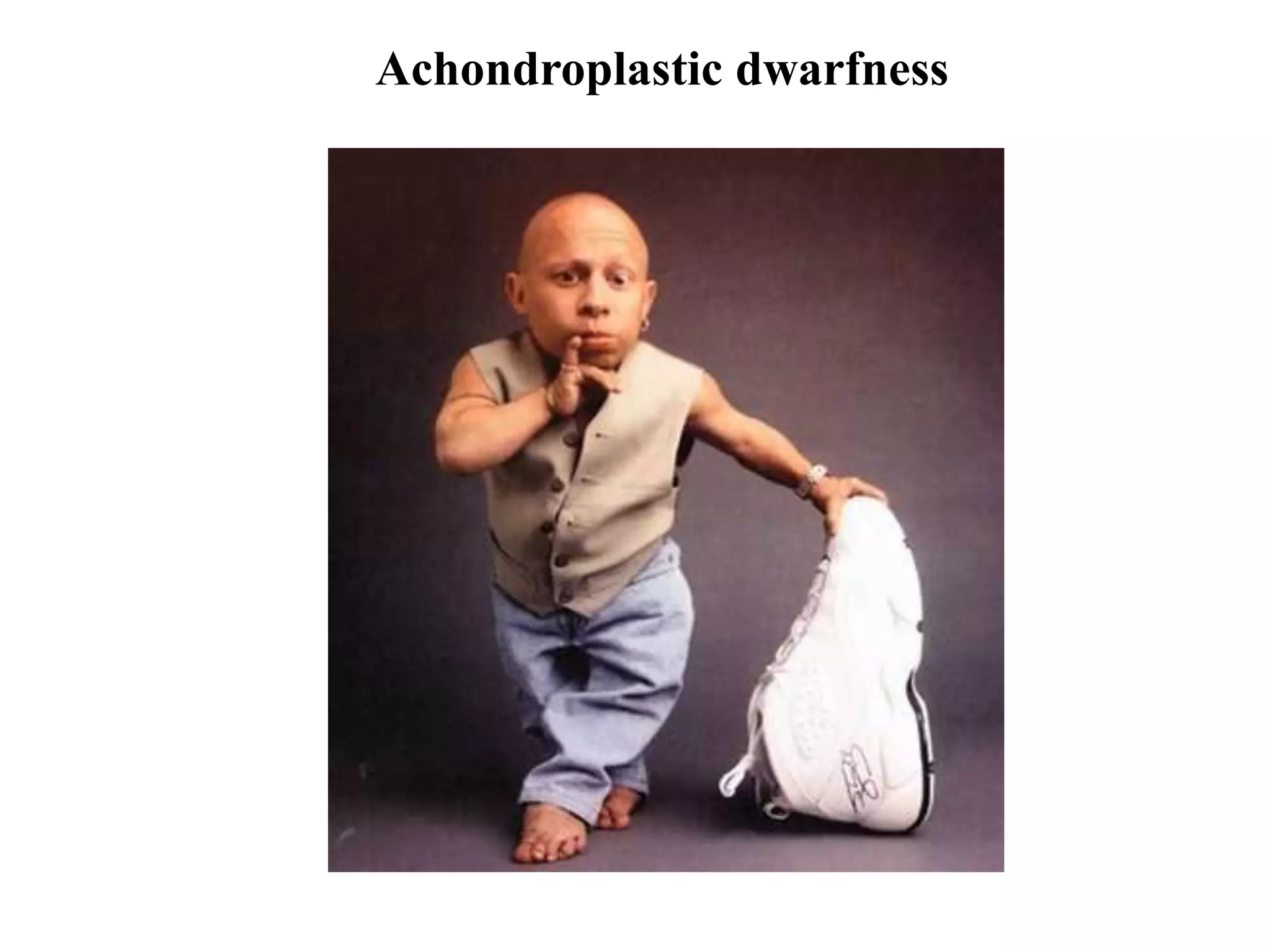 Achondroplastic dwarfness
 