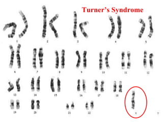 Turner’s Syndrome 