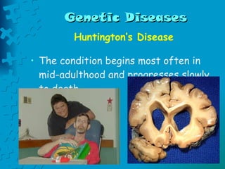 Genetic Diseases Huntington’s Disease The condition begins most often in mid-adulthood and progresses slowly to death.  