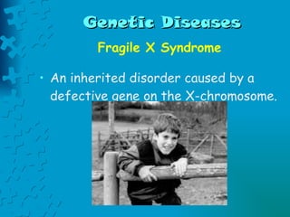 Genetic Diseases Fragile X Syndrome An inherited disorder caused by a defective gene on the X-chromosome. 