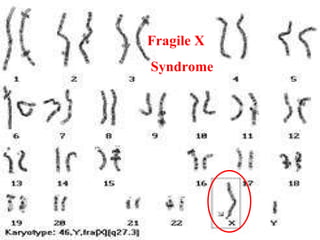 Fragile X Syndrome 