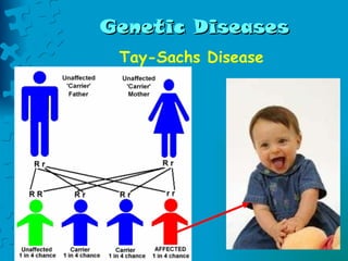 Genetic Diseases Tay-Sachs Disease 