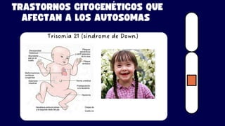 TRASTORNOS CITOGENÉTICOS QUE
AFECTAN A LOS AUTOSOMAS
Trisomía 21 (síndrome de Down)
 