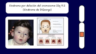 Síndrome por deleción del cromosoma 22q 11.2
(Síndrome de DiGeorge)
 