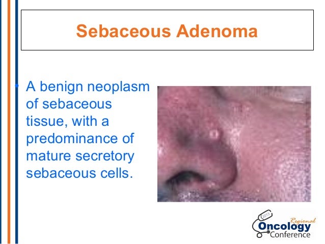 test blood septin 9 Cancer 2013: Genomics is Genomics Genetics and in How