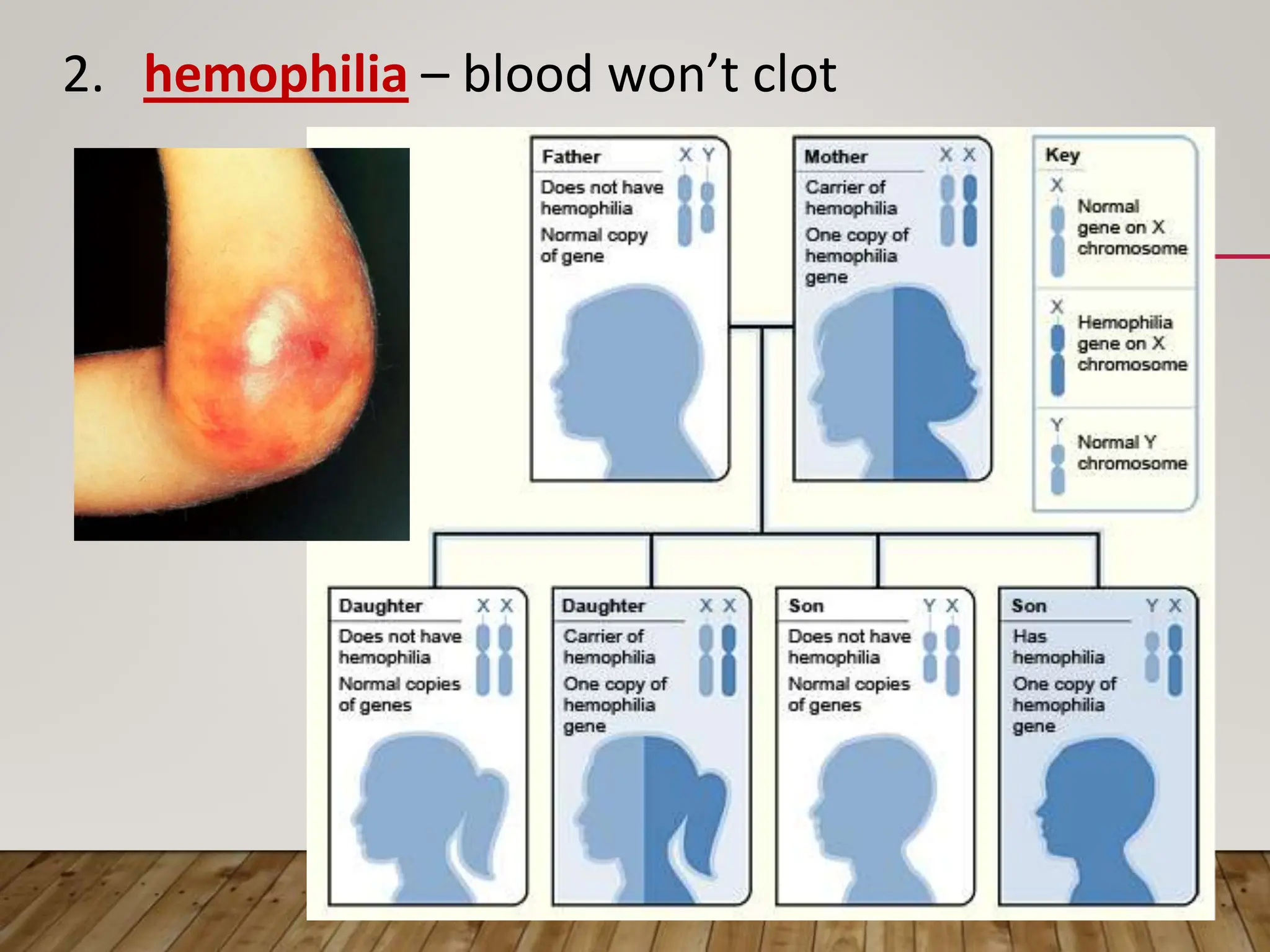 2. hemophilia – blood won’t clot
 