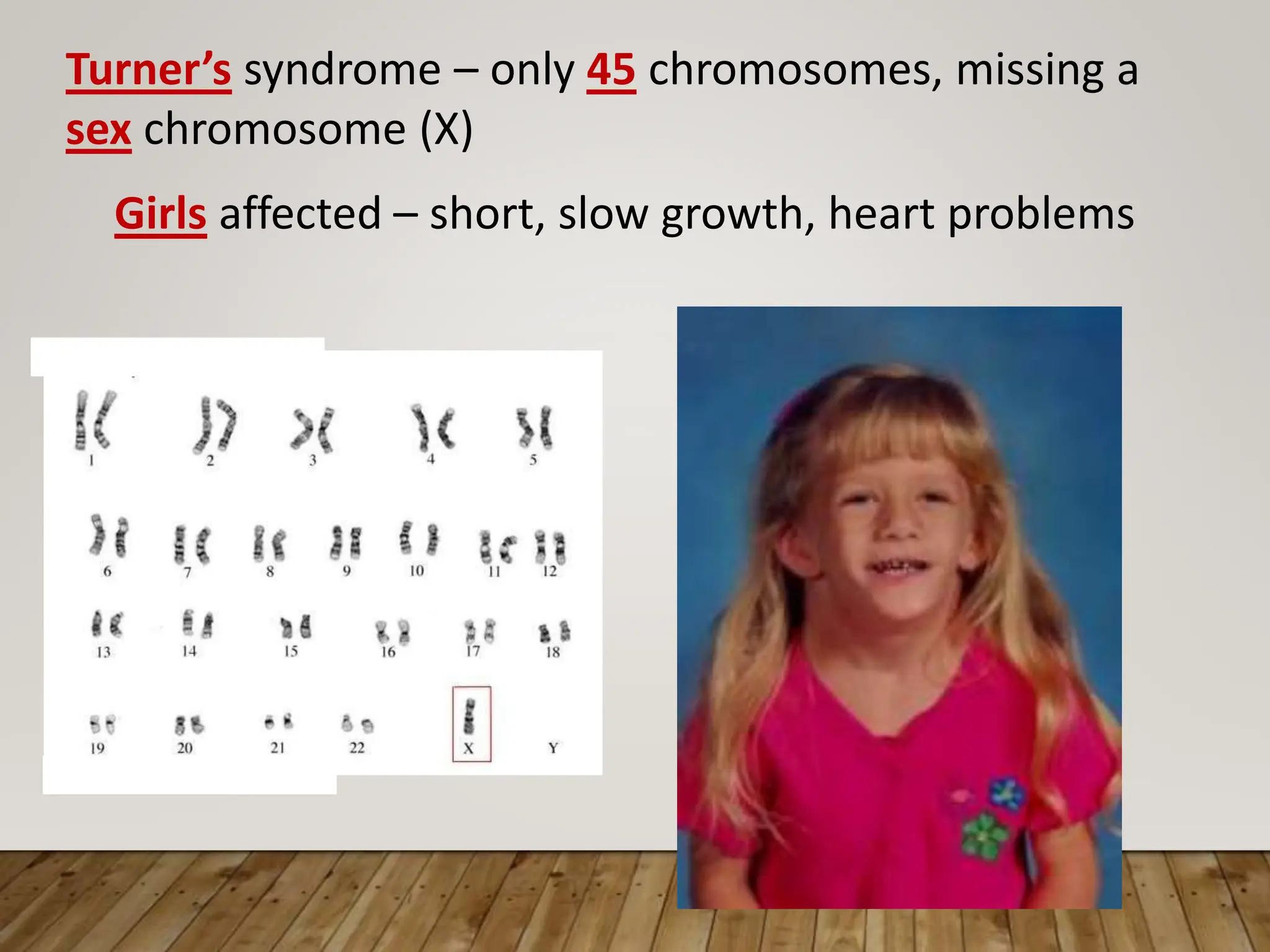 Turner’s syndrome – only 45 chromosomes, missing a
sex chromosome (X)
Girls affected – short, slow growth, heart problems
 