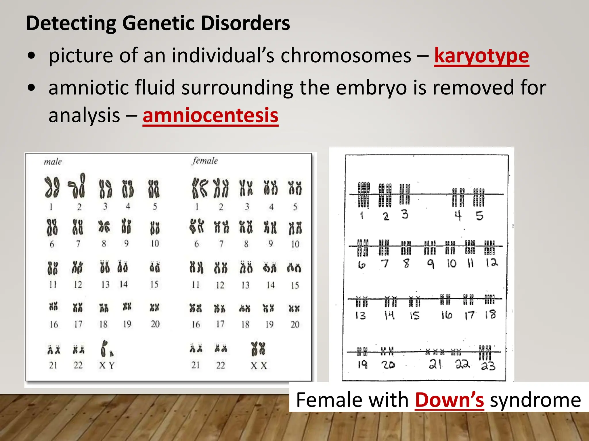 Detecting Genetic Disorders
• picture of an individual’s chromosomes – karyotype
• amniotic fluid surrounding the embryo is removed for
analysis – amniocentesis
Female with Down’s syndrome
 