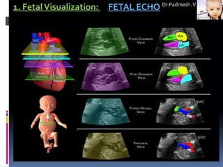 1. Fetal Visualization:   FETAL ECHO Dr.Padmesh. V
 