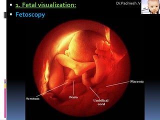  1. Fetal visualization:   Dr.Padmesh. V


 Fetoscopy
 