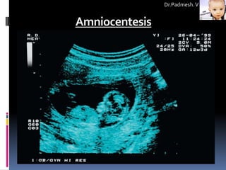 Dr.Padmesh. V


Amniocentesis
 